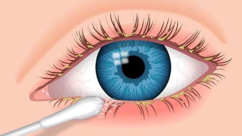 Vệ sinh bờ mi hàng ngày là biện pháp giúp giảm khô mắt