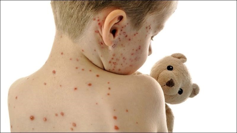 Thủy đậu gây mụn nước trên da
