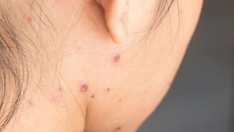 Nếu không được chăm sóc kĩ, mụn nước vỡ sẽ để lại sẹo