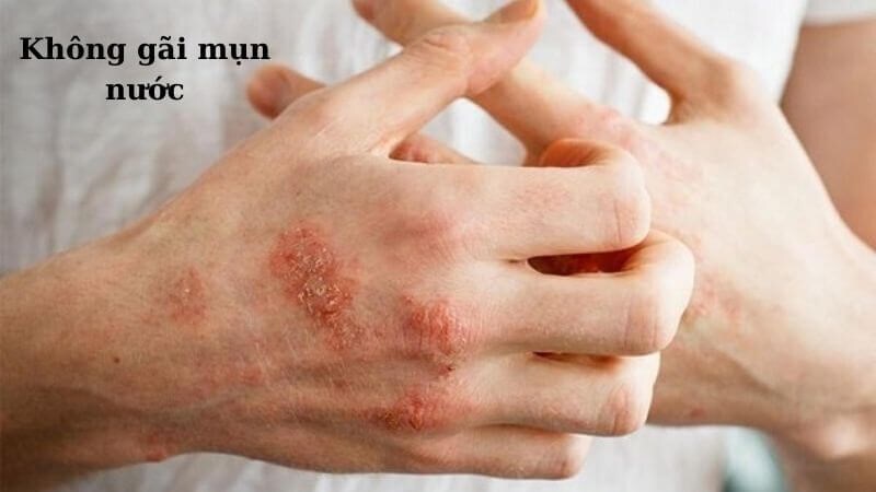 Không gãi hay chạm vào mụn nước