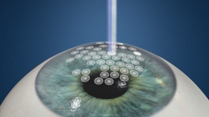 Người bệnh có thể được chỉ định phẫu thuật PRK giúp chữa loạn thị Người bệnh có thể được chỉ định phẫu thuật PRK giúp chữa loạn thị