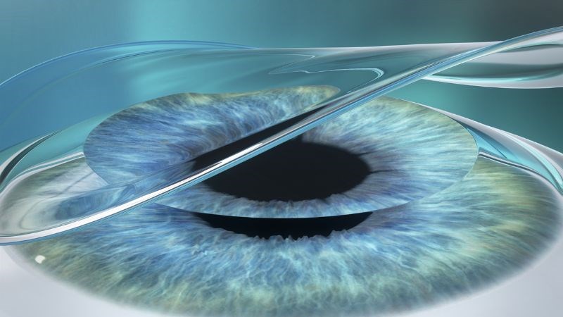 Loạn thị có thể được điều trị hiệu quả nhờ phẫu thuật LASEK Loạn thị có thể được điều trị hiệu quả nhờ phẫu thuật LASEK