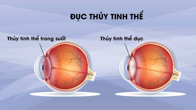 Đục thủy tinh thể gây giảm thị lực của người bệnh