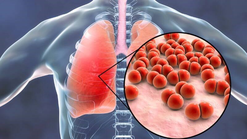 Sởi có thể dẫn tới biến chứng viêm phổi