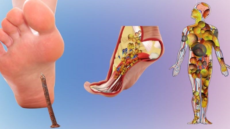 Uốn ván là bệnh truyền nhiễm nguy hiểm gây ra bởi ngoại độc tố vi khuẩn Clostridium tetani