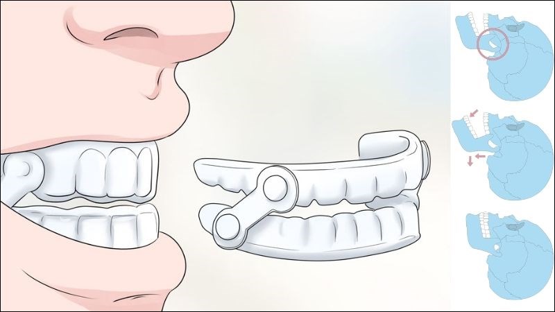 Sử dụng miếng chống nghiến răng có thể giúp giảm đau khớp thái dương hàm