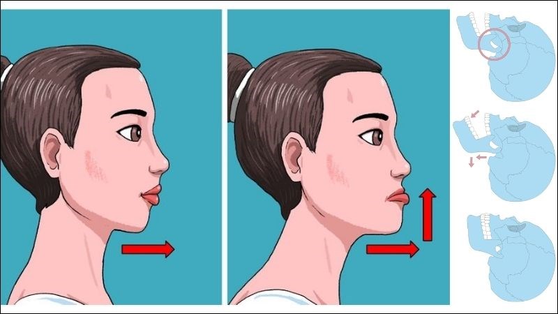 Bài tập chuyển động hàm về phía trước giúp tăng tính di động cho khớp thái dương hàm