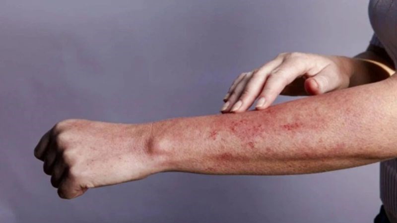 Người nhiễm HIV nếu không điều trị sẽ sớm dẫn đến giai đoạn AIDS