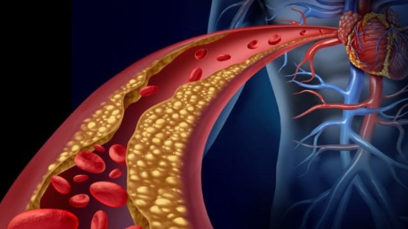 Không thể chữa khỏi bệnh mạch vành nhưng có thể kiểm soát các yếu tố gây bệnh