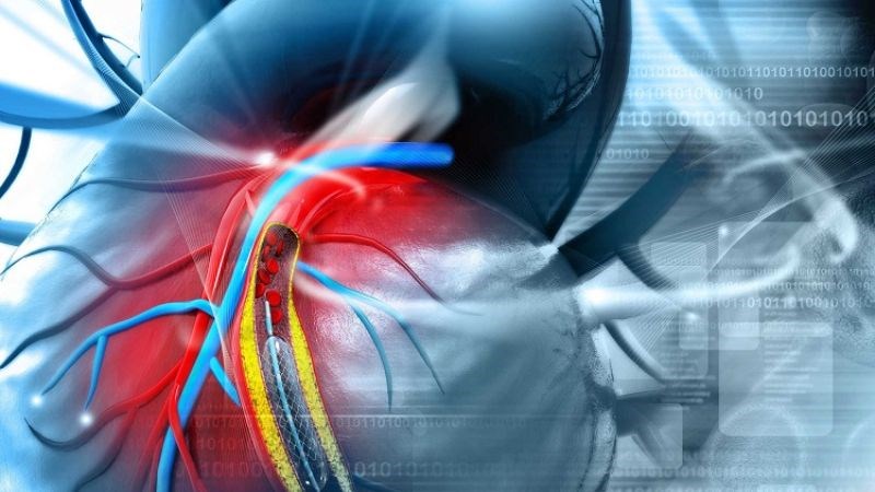 Can thiệp động mạch vành qua da giúp tái thông động mạch vành