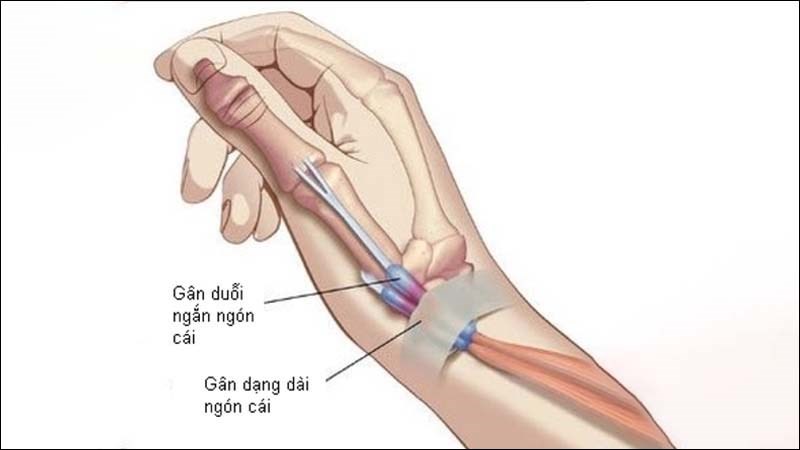 Операция на большом пальце руки. Лигаментит сухожилия сгибателя. Стенозирующий лигаментит де Кервена. Стенозирующий лигаментит. Болезнь Нотта.