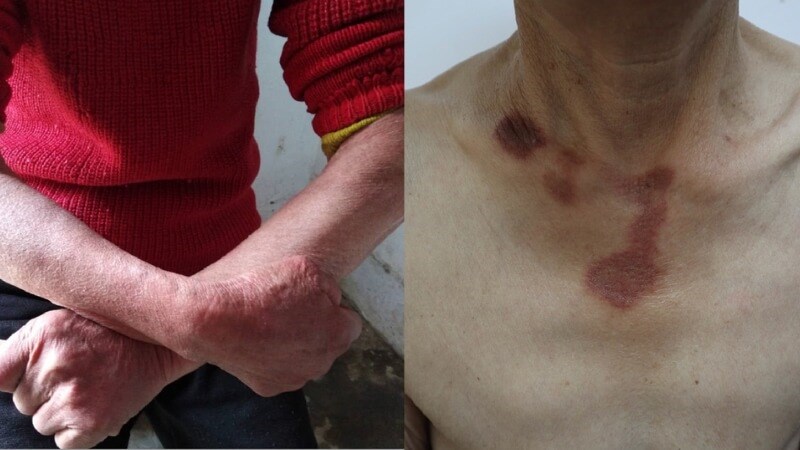 Bệnh Pellagra là gì? Nguyên nhân, triệu chứng và cách điều trị