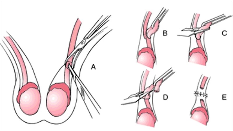 Phương pháp thắt ống dẫn tinh