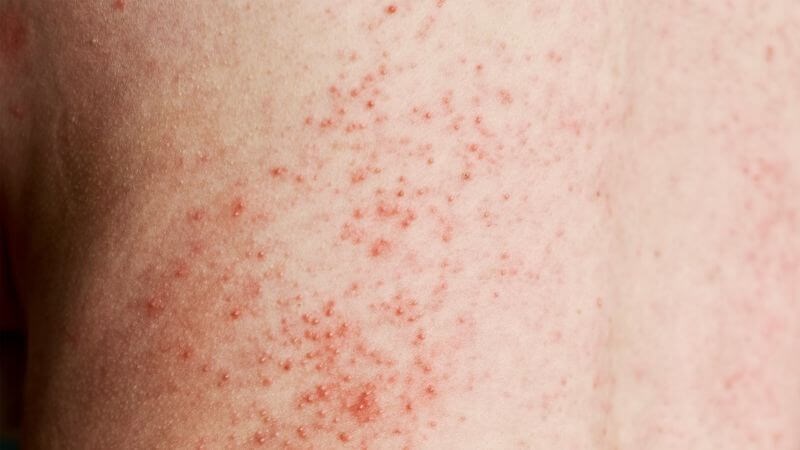 Viêm màng não ở người lớn có thể xuất hiện phát ban trên da
