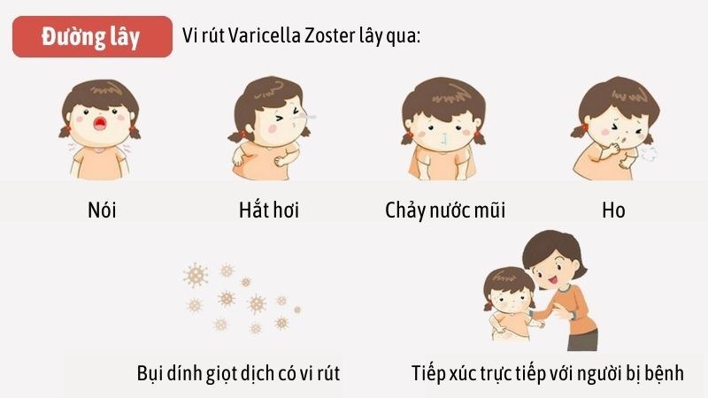 Người bị thủy đậu có khả năng lây bệnh cho người xung quanh