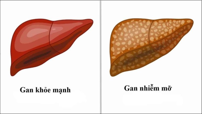 Bệnh gan nhiễm mỡ là tình trạng tích tụ chất béo trong gan