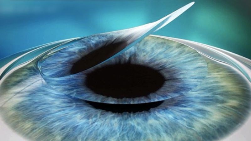 Phẫu thuật LASIK được sử dụng phổ biến hiện nay