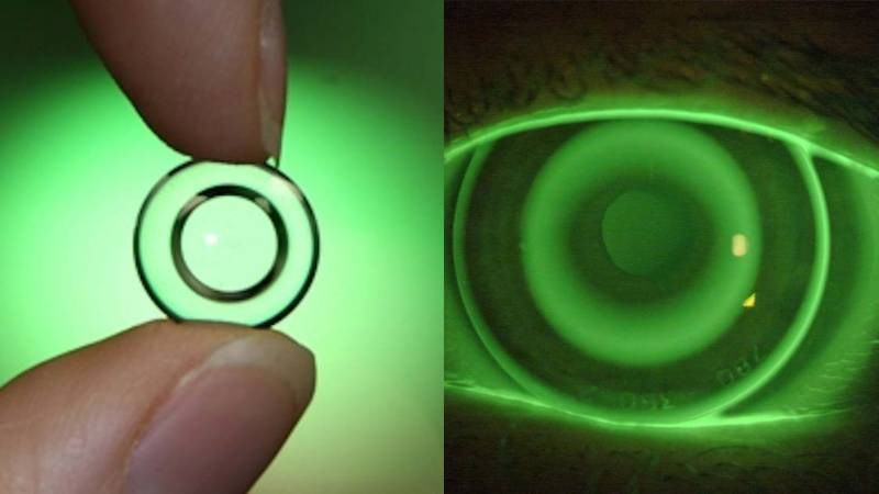 Thấu kính đêm có thể được dùng để làm chậm lên độ cận