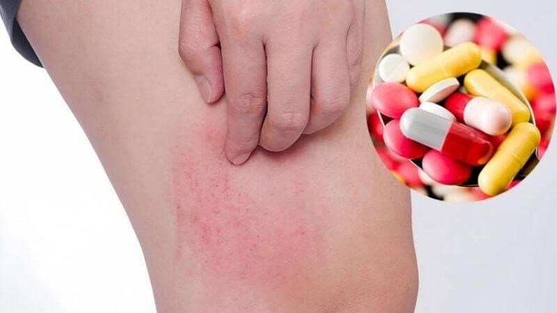 Thuốc phá thai có thể gây dị ứng, biểu hiện như nổi mề đay, mẩn ngứa, choáng váng...