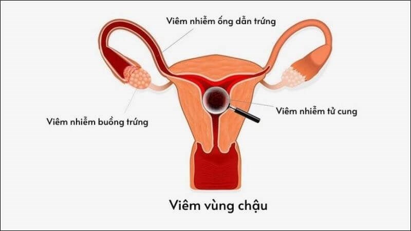 Bệnh viêm vùng chậu thường gặp tình trạng đau mãn tính kéo dài, tăng nguy cơ mang thai ngoài tử cung, vô sinh