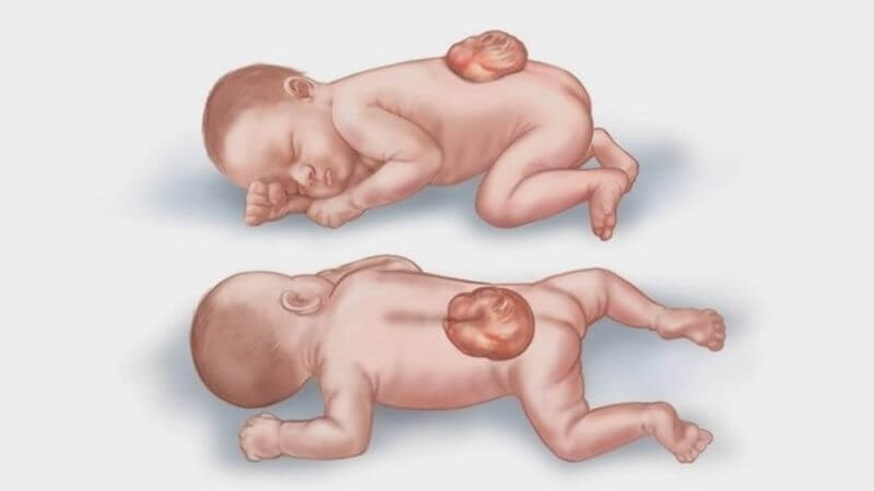 Thuốc phá thai có thể gây dị tật thai nhi