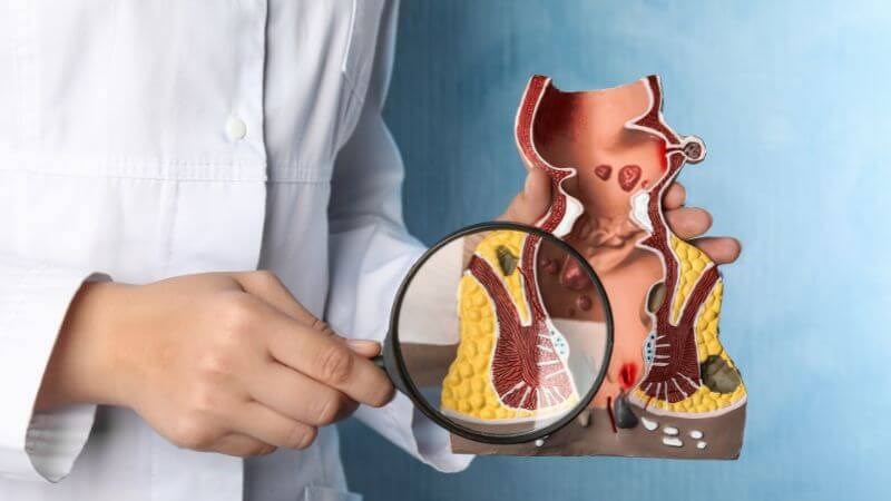 Dựa vào vị trí mạch máu sưng ở hậu môn hoặc trực tràng mà người ta chia trĩ thành hai loại Dựa vào vị trí mạch máu sưng ở hậu môn hoặc trực tràng mà người ta chia trĩ thành hai loại