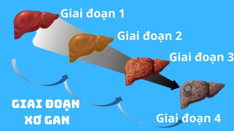 Xơ gan có 4 giai đoạn tương ứng với các mức độ tổn thương gan tương ứng
