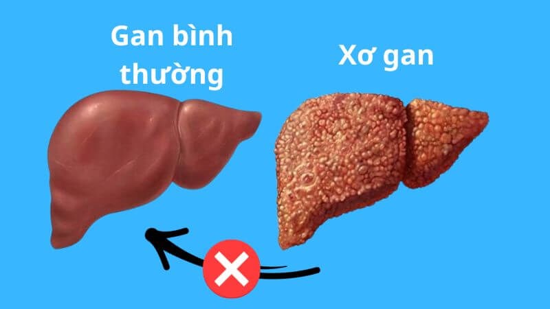 Hiện nay, các phương pháp điều trị không thể điều trị khỏi xơ gan