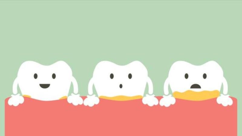 Cao răng là các mảng bám trên bề mặt răng do sự tích tụ của thức ăn Cao răng là các mảng bám trên bề mặt răng do sự tích tụ của thức ăn