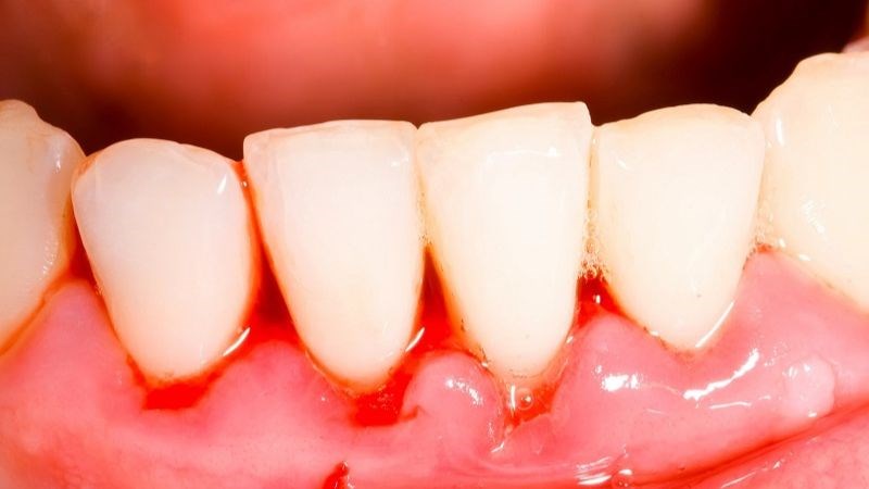 Lấy cao răng không cẩn thận có thể dẫn đến chảy máu chân răng Lấy cao răng không cẩn thận có thể dẫn đến chảy máu chân răng