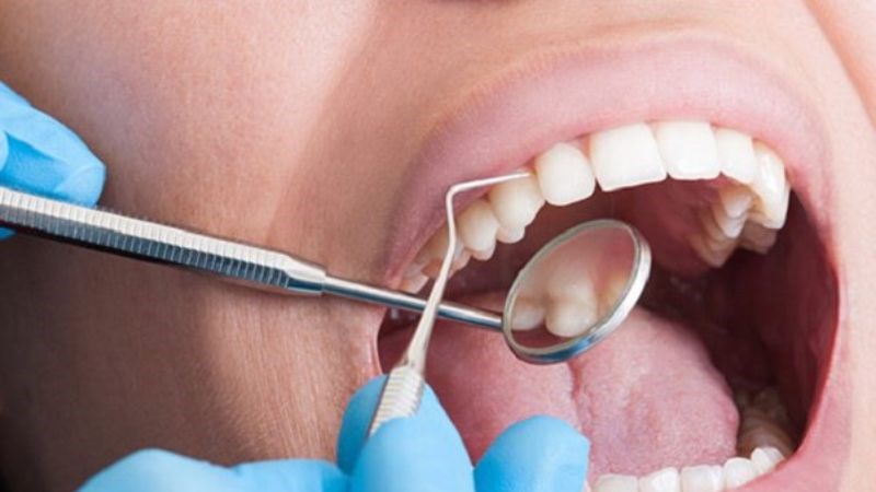 Bạn nên lấy cao răng định kỳ để tránh bệnh lý răng miệng Bạn nên lấy cao răng định kỳ để tránh bệnh lý răng miệng