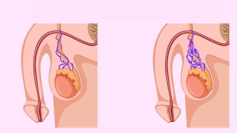 Giãn tĩnh mạch thừng tinh có thể do van tĩnh mạch suy yếu gây ứ đọng tuần hoàn