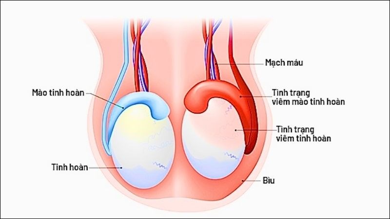 Viêm tinh hoàn và viêm mào tinh hoàn có thể dẫn đến sưng bìu tinh hoàn