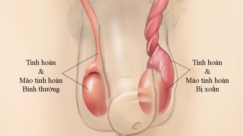 Xoắn tinh hoàn gây cản trở hoặc ngăn chặn dòng máu đến tinh hoàn