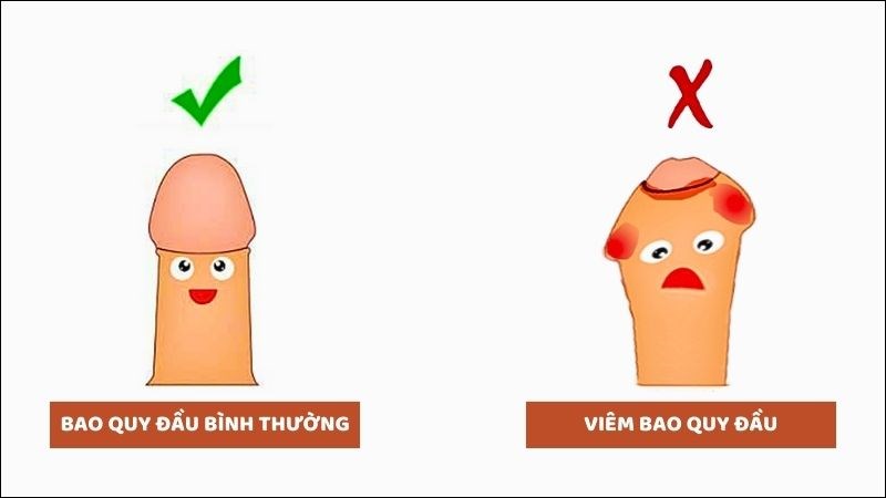 Viêm bao quy đầu là tình trạng viêm tại chỗ vùng bao quy đầu và quy đầu