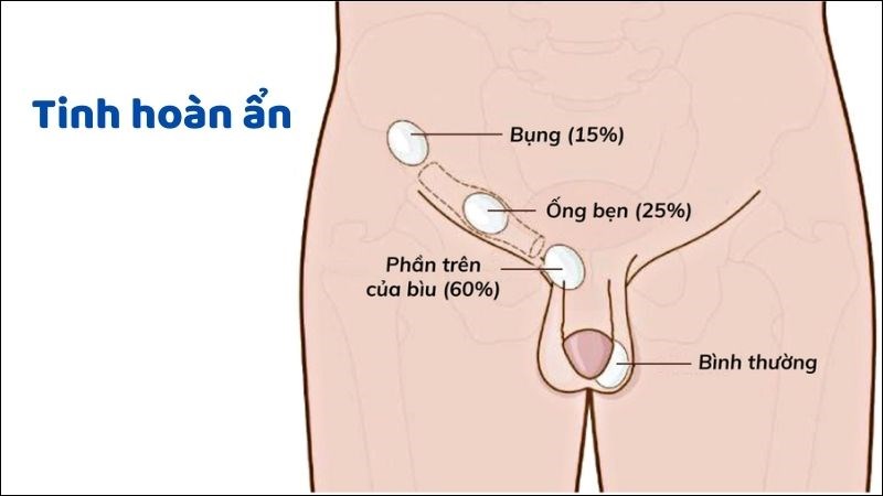 Tinh hoàn ẩn là tình trạng tinh hoàn nằm trong ổ bụng hoặc ở vùng bẹn