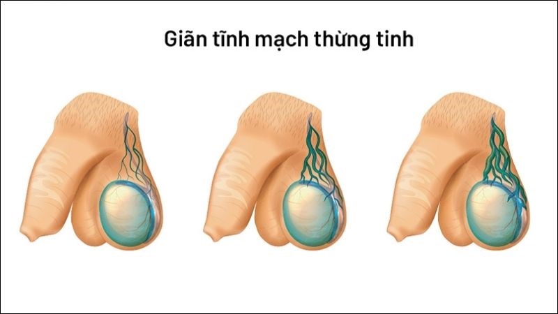 Giãn tĩnh mạch thừng tinh làm mất áp lực tống máu ra khỏi tinh hoàn gây ứ máu và đau