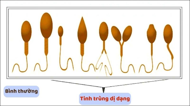 Tinh trùng bị khiếm khuyết một phần đầu, thân hoặc đuôi là tinh trùng dị dạng