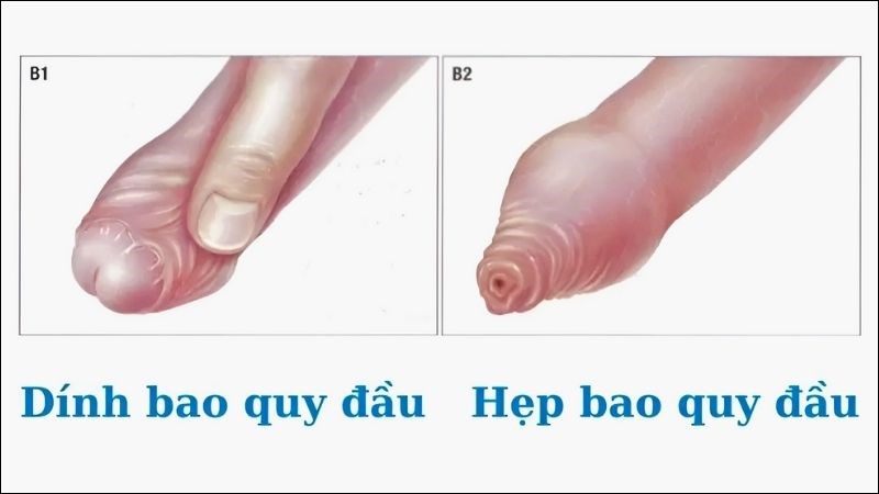 Dính bao quy đầu là một biến chứng tiềm ẩn sau khi phẫu thuật cắt bao quy đầu