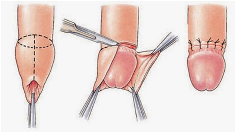 Bao quy đầu dài là tình trạng bao da quy đầu quá dài và che kín cả lỗ tiểu