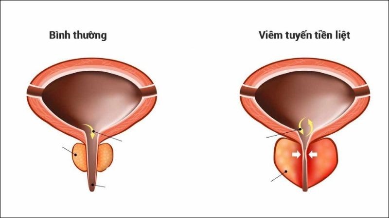 Bệnh viêm tuyến tiền liệt dễ gây nhiễm trùng huyết và nhiễm trùng các cơ quan lân cận