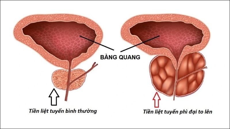 Tuyến tiền liệt phì đại sẽ chèn ép lên niệu đạo và gây tắc nghẽn đường tiểu