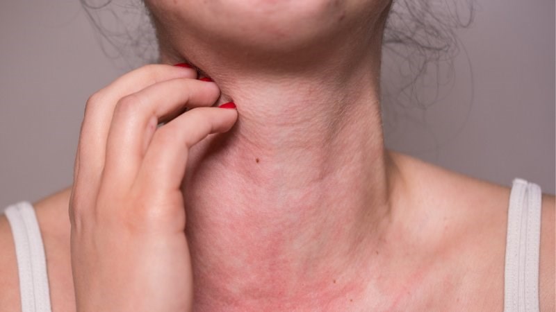 Theo dõi các dấu hiệu phản ứng dị ứng khi sử dụng bồ công anh