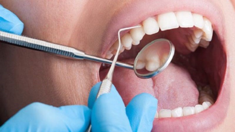 Bạn nên đến gặp nha sĩ 6 tháng 1 lần