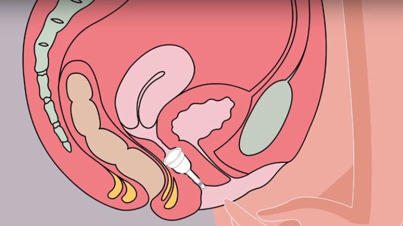 Chiều cao cổ tử cung liên quan đến việc lựa chọn chiều dài cốc nguyệt san
