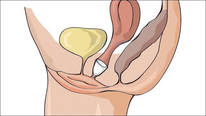 Chiều dài cốc nguyệt san cần phải phù hợp với chiều dài âm đạo