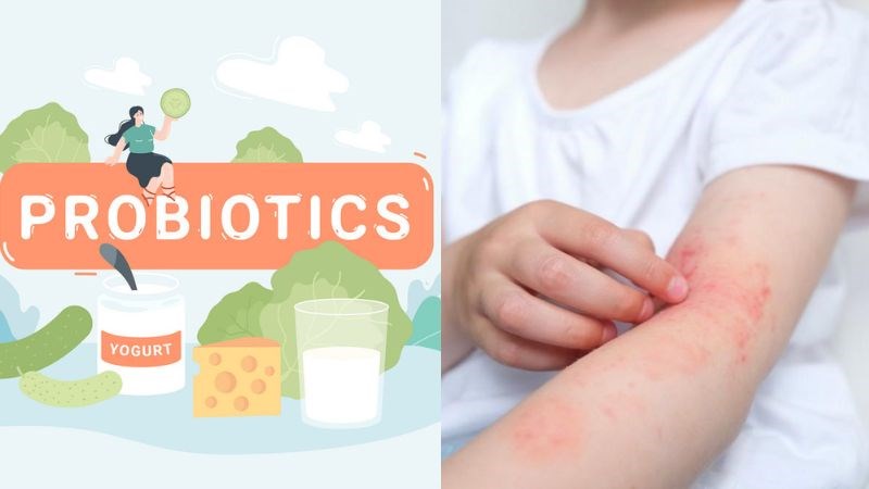 Men vi sinh giúp phòng và hỗ trợ điều trị viêm da dị ứng Men vi sinh giúp phòng và hỗ trợ điều trị viêm da dị ứng