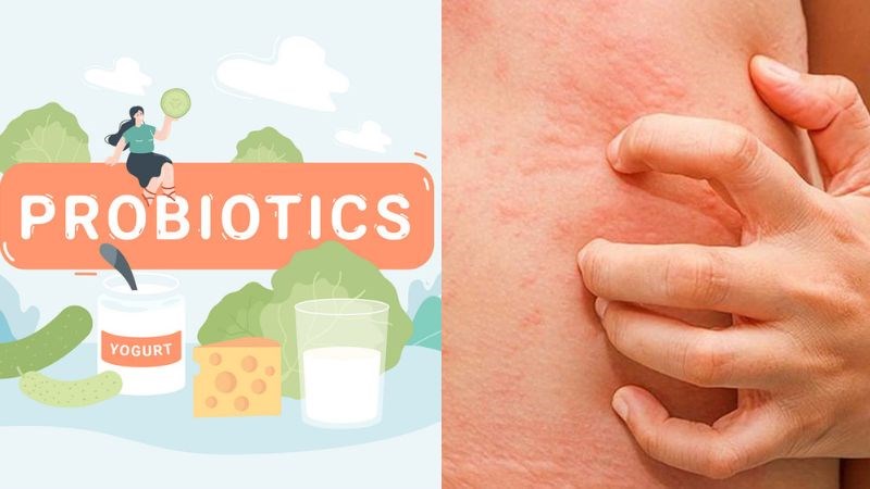 Men vi sinh có tác dụng phòng ngừa dị ứng Men vi sinh có tác dụng phòng ngừa dị ứng