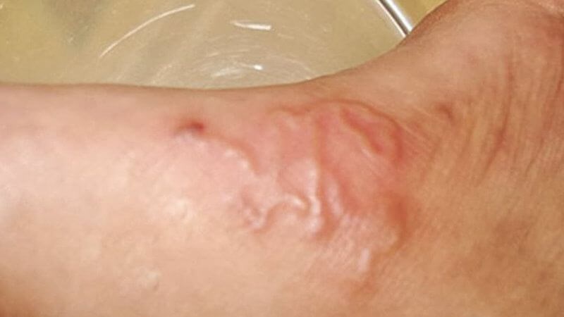 Quan sát trên da người nhiễm sán lợn có thể phát hiện sán