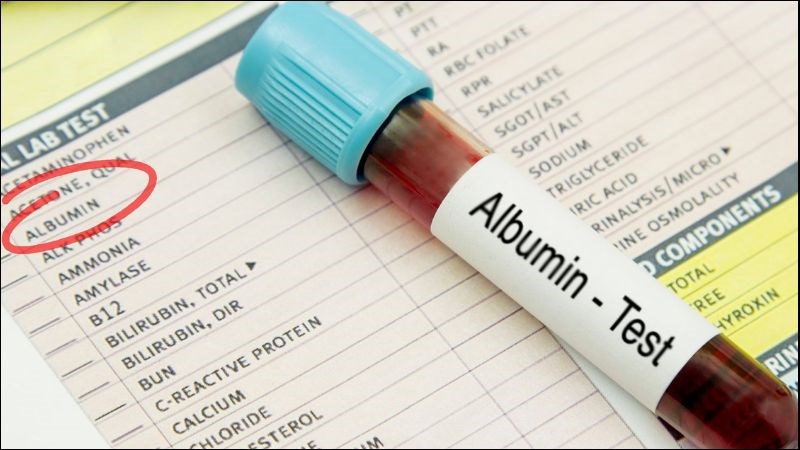 Xét nghiệm Albumin máu để xác định có rò rỉ dịch không